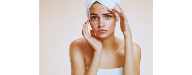 Understanding Hormonal Acne: Causes, Treatments, and Prevention During Menstruation